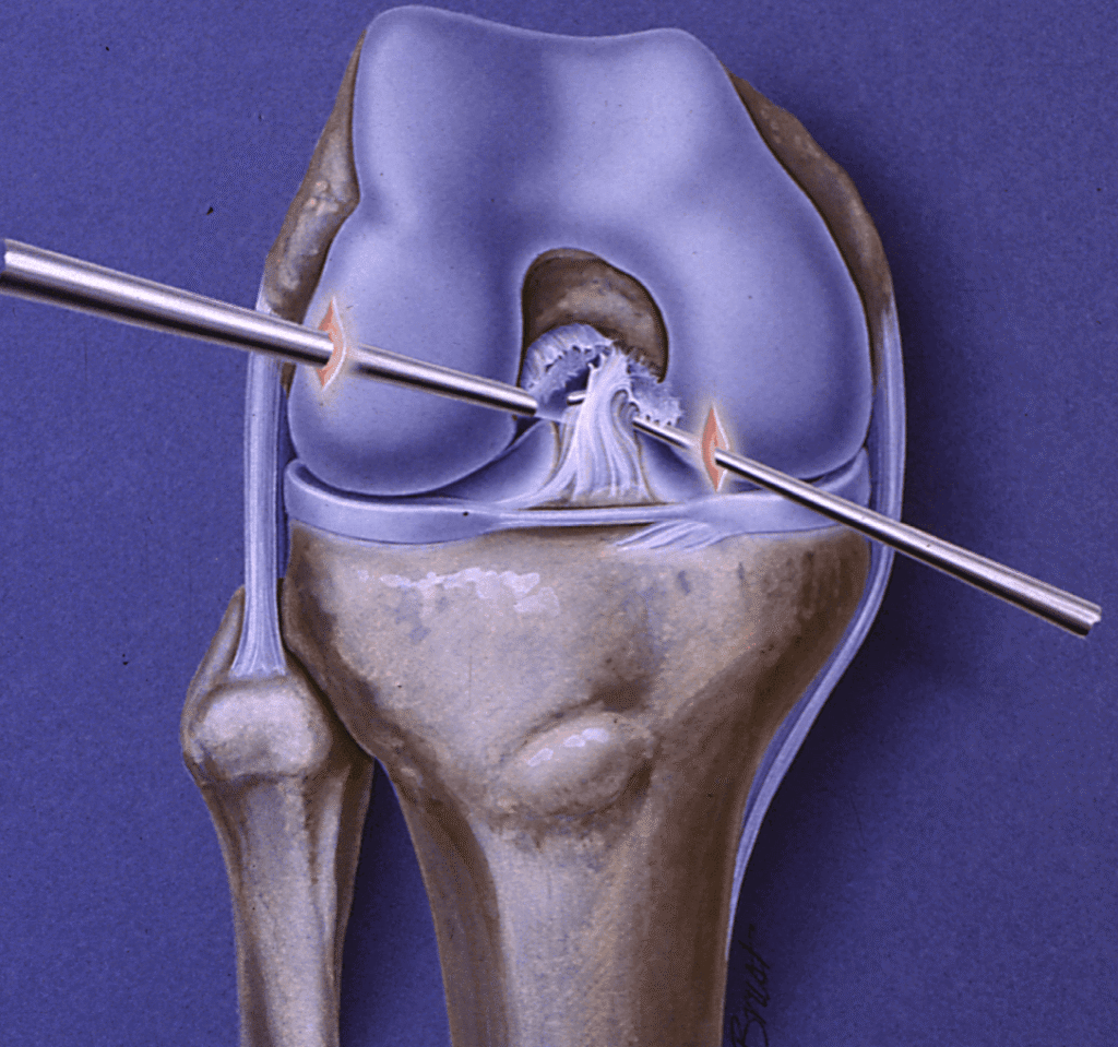 ACL Reconstruction in Bahadurpura, Hyderabad