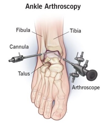 Ankle Arthroscopy in Bahadurpura, Hyderabad