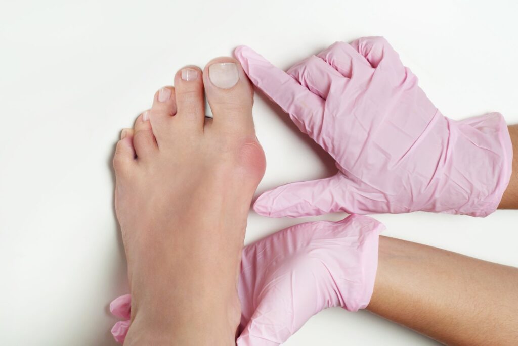Bunion Surgery in Bahadurpura, Hyderabad