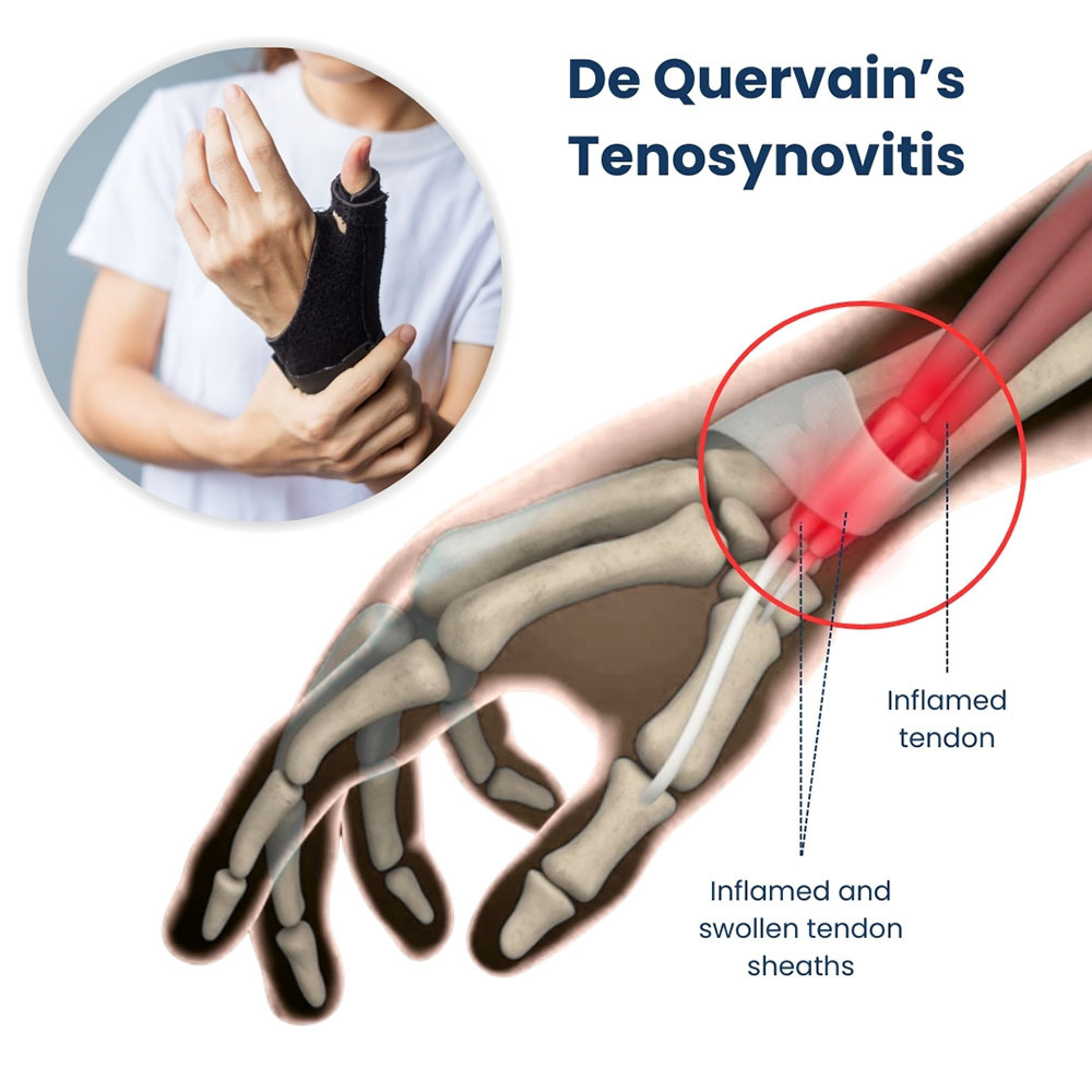 De Quervain’s Tenosynovitis