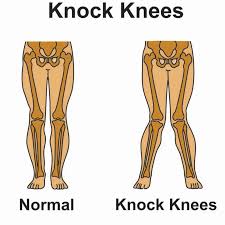 Genu Valgum (Knock Knees) Treatment in Bahadurpura, Hyderabad