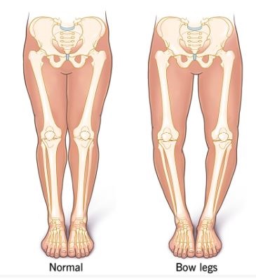 Genu Varum (Bow Legs) Treatment in Bahadurpura, Hyderabad
