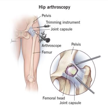 Hip Arthroscopy in Bahadurpura, Hyderabad