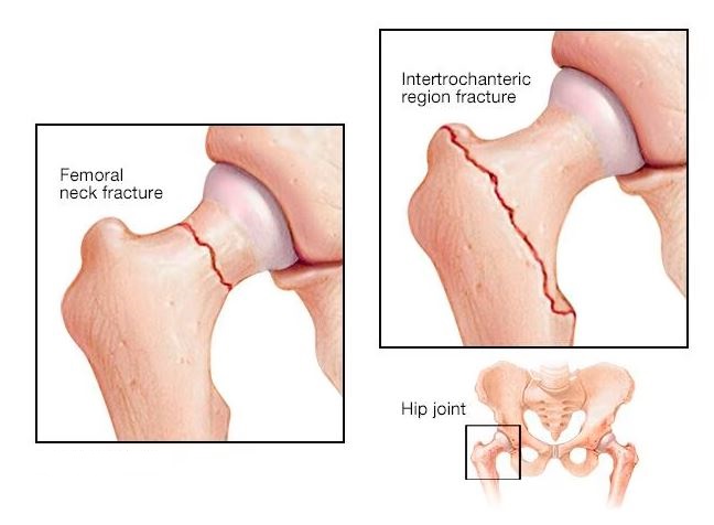 Hip Fracture Fixation in Bahadurpura, Hyderabad