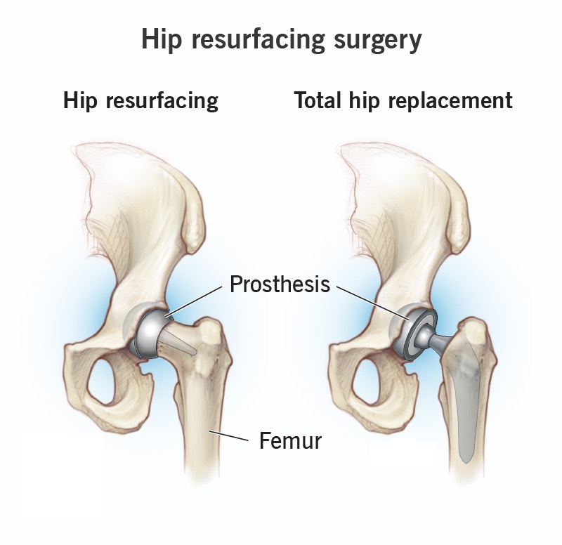 Hip Resurfacing in Bahadurpura, Hyderabad