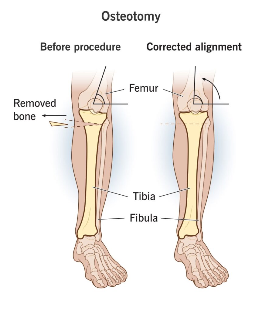 Knee Osteotomy in Bahadurpura, Hyderabad