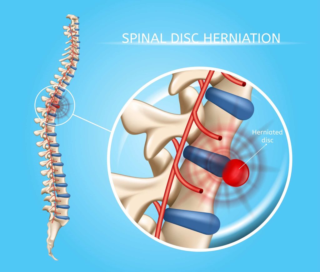 Lumbar Disc Herniation Treatment in Bahadurpura, Hyderabad