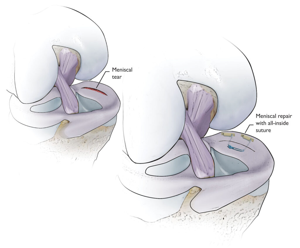 Meniscus Repair in Bahadurpura, Hyderabad
