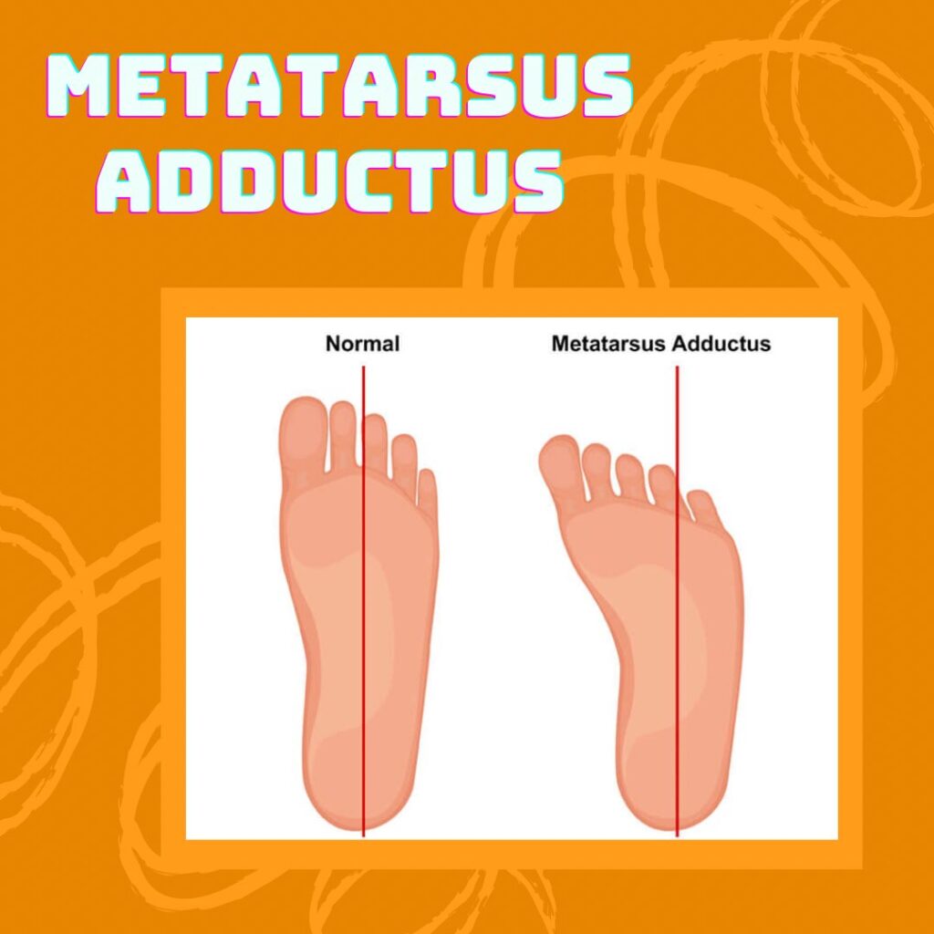 Metatarsus Adductus Treatment in Bahadurpura, Hyderabad
