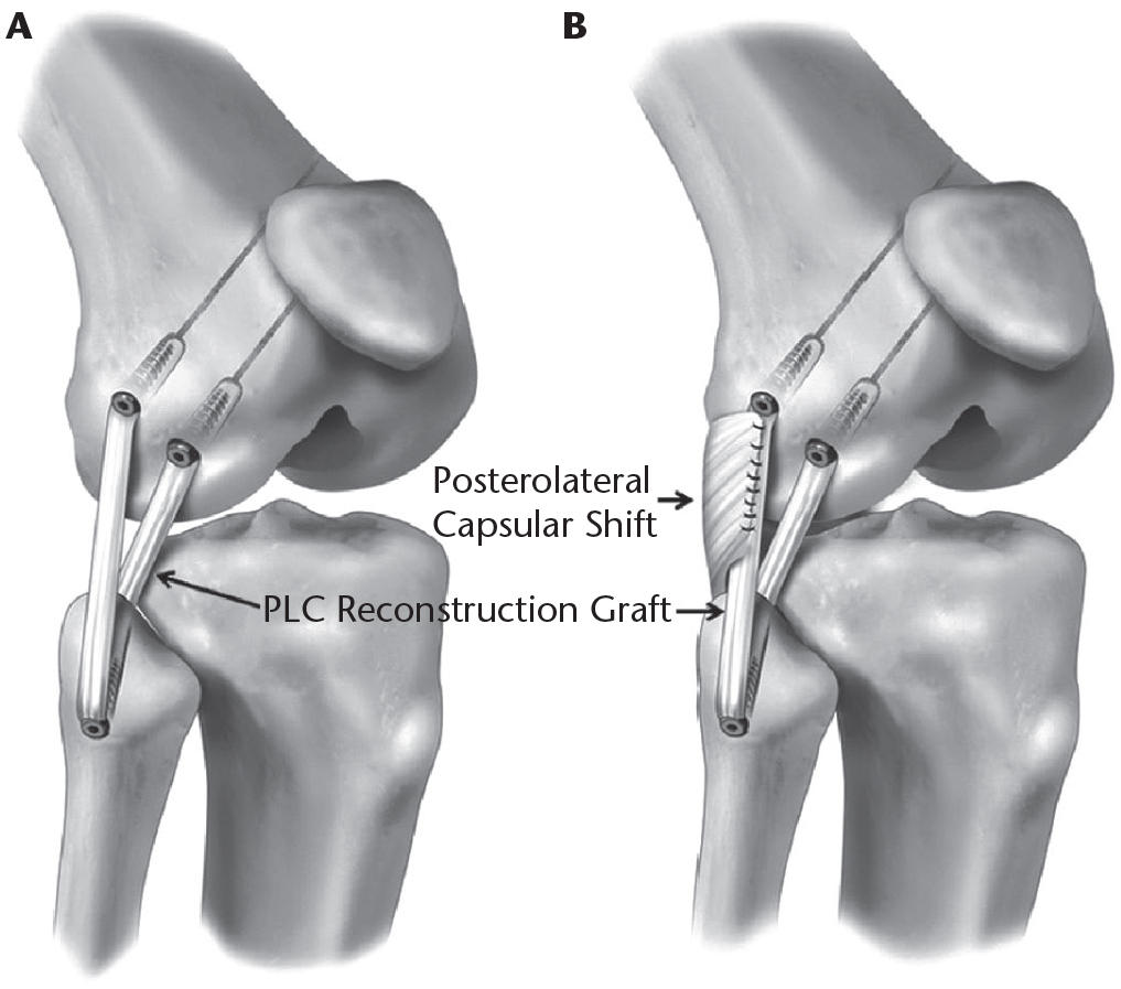 Multiligament Knee Reconstruction in Bahadurpura, Hyderabad
