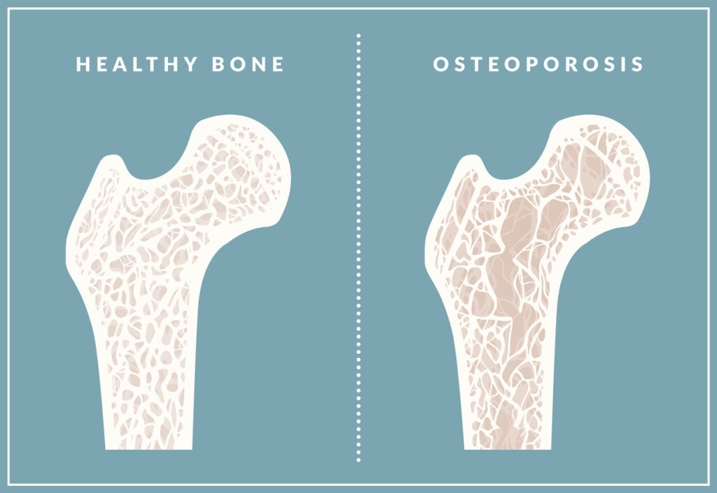 Osteoporosis Treatment in Bahadurpura, Hyderabad
