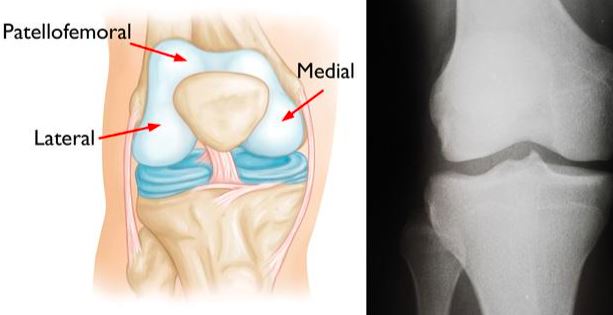 Partial Knee Replacement in Bahadurpura, Hyderabad