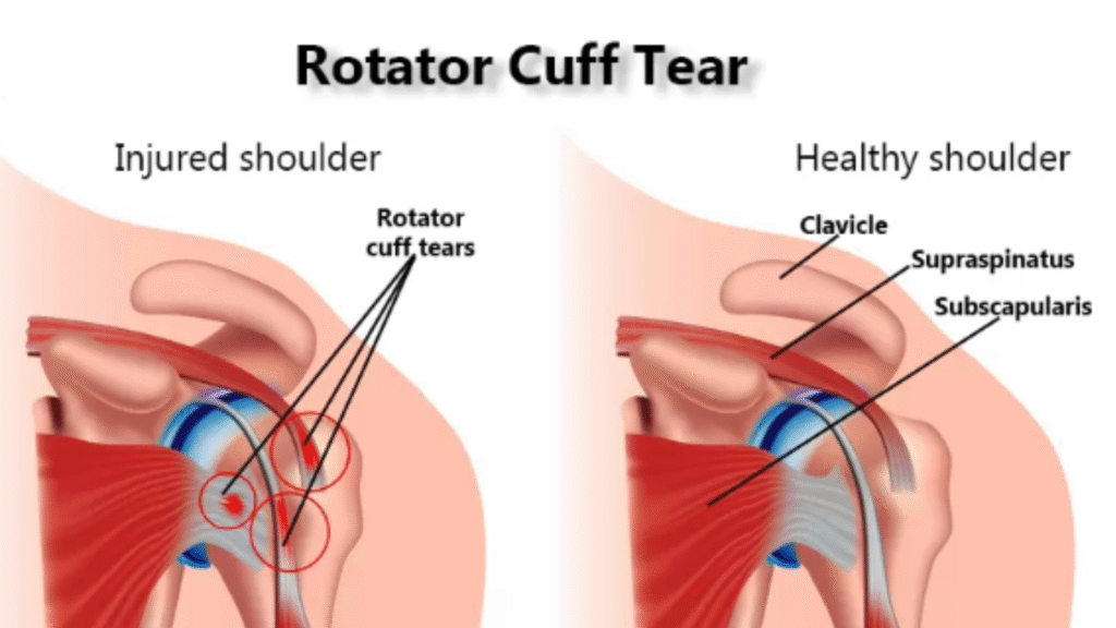 Rotator Cuff Injury Treatment in Bahadurpura, Hyderabad