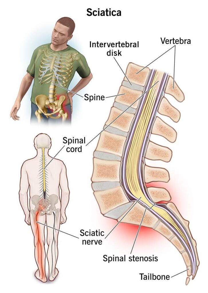 Sciatica Treatment in Bahadurpura, Hyderabad