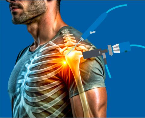 Shoulder Arthroscopy in Bahadurpura, Hyderabad