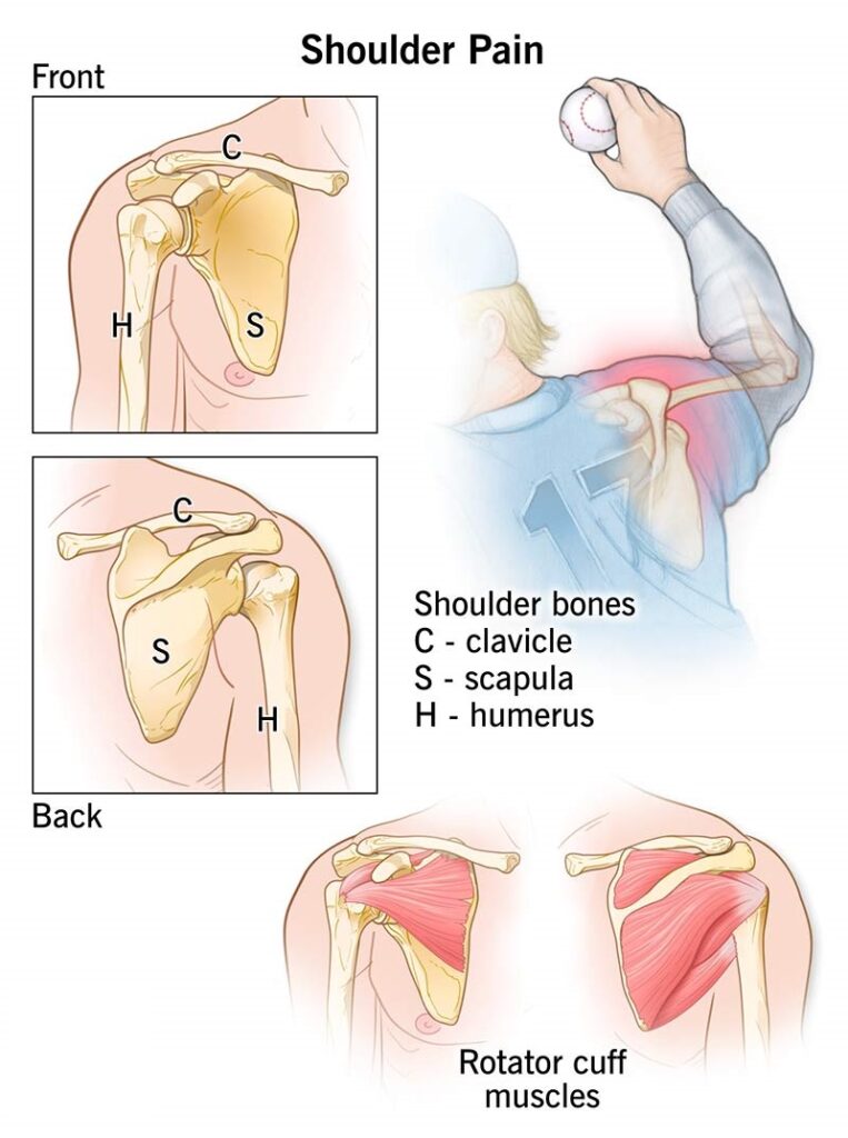 Shoulder Impingement Syndrome in Bahadurpura, Hyderabad