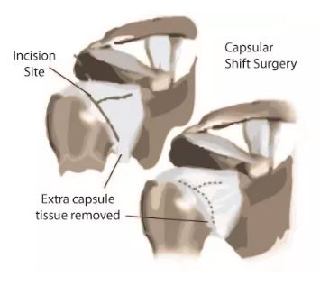 Shoulder Stabilization Surgery in Bahadurpura, Hyderabad