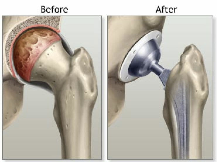 Total Hip Replacement (THR) in Bahadurpura, Hyderabad