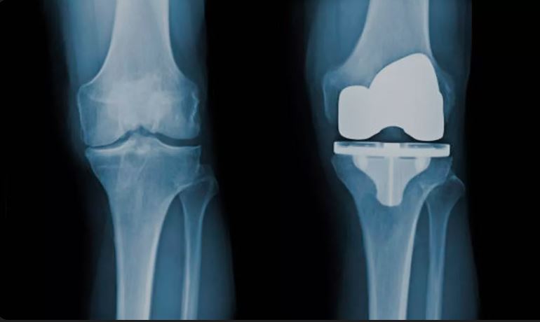 Total Knee Replacement (TKR) in Bahadurpura, Hyderabad