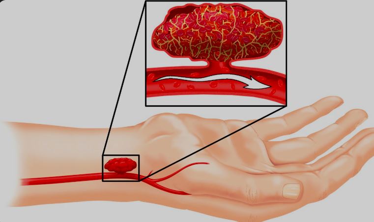 Upper Limb Surgery in Bahadurpura, Hyderabad
