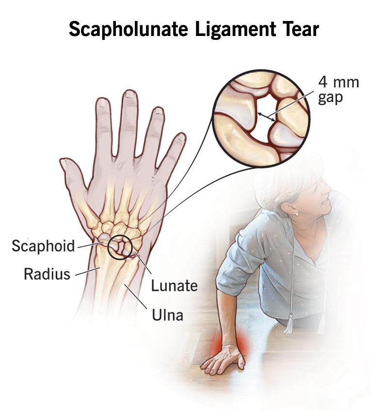 Wrist Sprain Treatment in Bahadurpura, Hyderabad