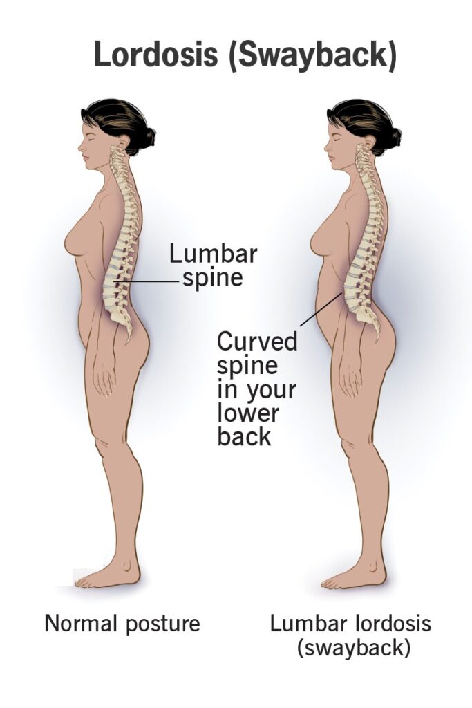 lordosis treatment
