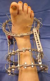 External Fixation