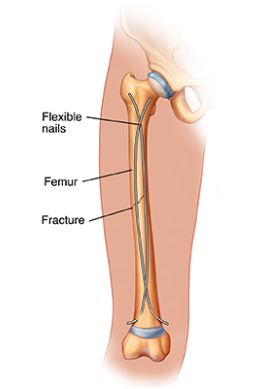 Open Reduction and Internal Fixation (ORIF)