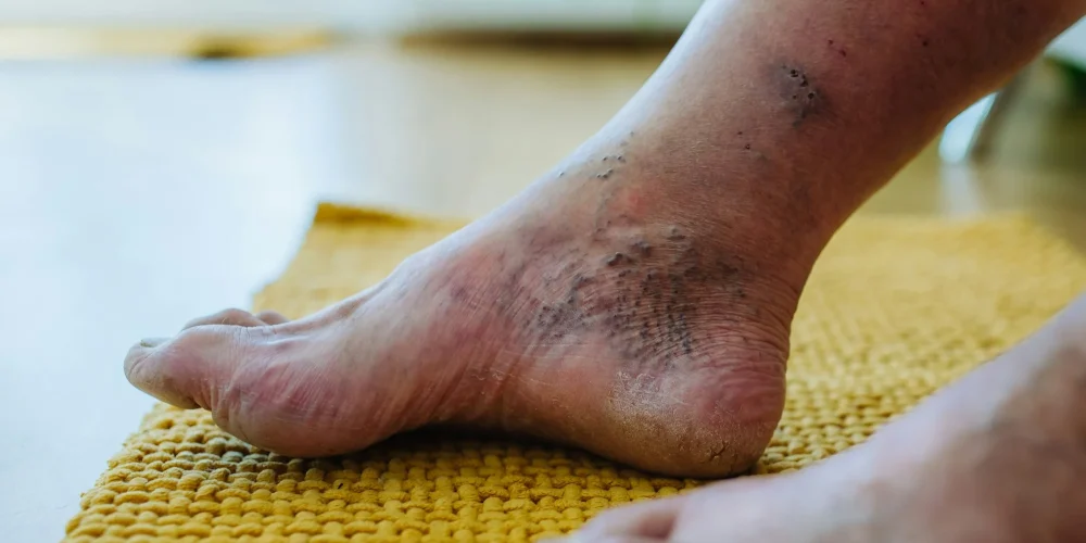 Amputation (in severe trauma or diabetic complications)